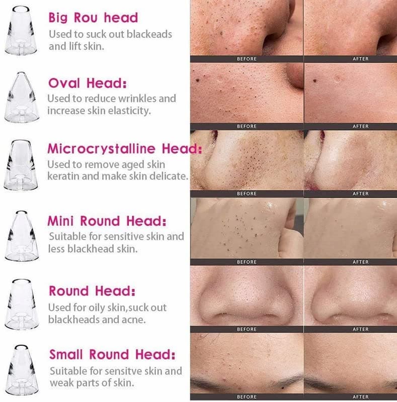Rechargeable Vacuum Pore Cleaner, 5 In 1 Blackheads Removing Device Electric Derma suction Machine | USB Rechargeable Acne Pimple Pore Cleaner Vacuum tool - Facial Cleanser Device for Nose & Skin Care